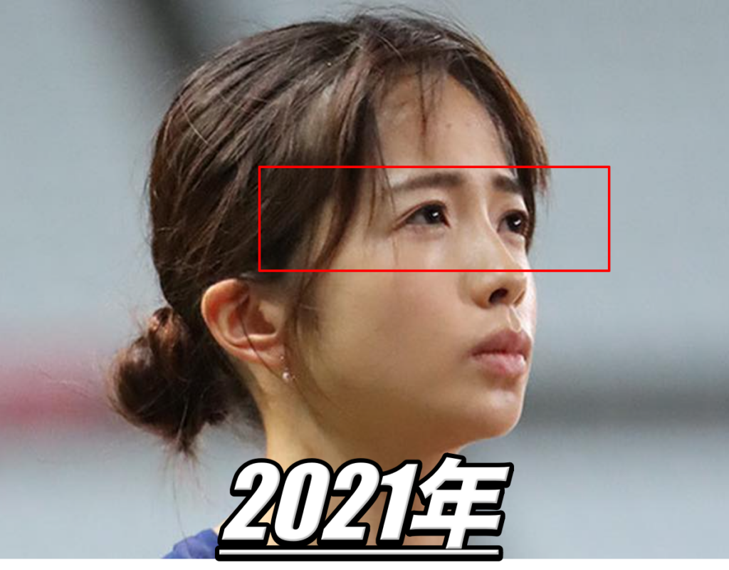 佐藤早也伽 目 整形の比較
